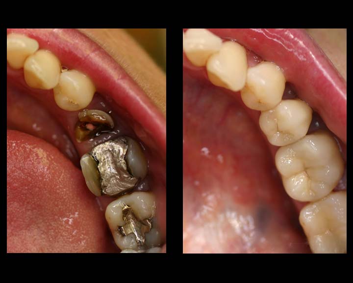 Keramikinlay - Denta Beaute