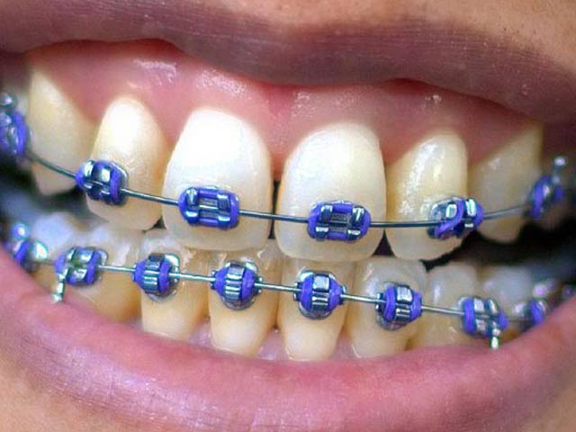 Brackets Denta Beaute