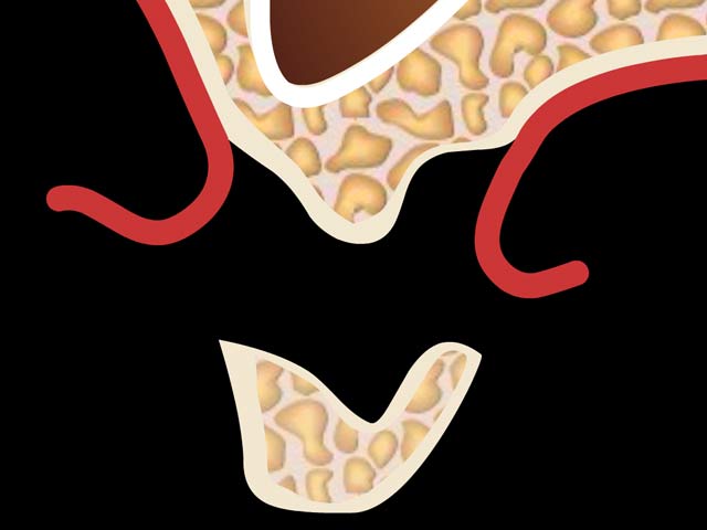 Osteoplastik Denta Beaute