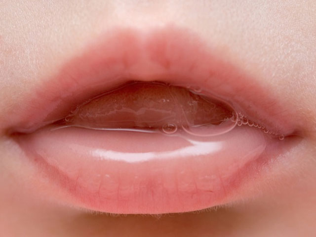 Produksi Air Liur Berlebih- Global Estetik Dental Care