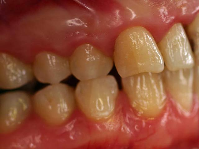 Zahnfleischbluten ist das Resultat einer entzündlichen Erkrankung des Zahnf...