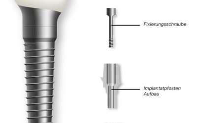 was soll ein Biozahnimplantat sein