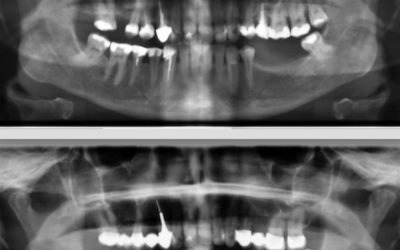 Zahnröntgen Besprechung Fall 2