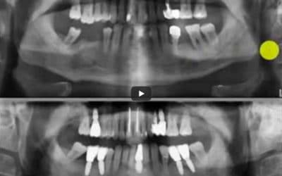 Zahnröntgen Besprechung Fall 4