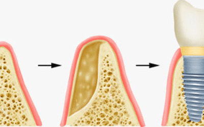 Knochenaufbau für Zahnimplantate