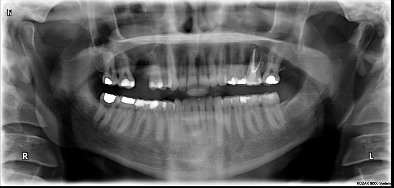 Wurzelbehandelter zahn wird grau