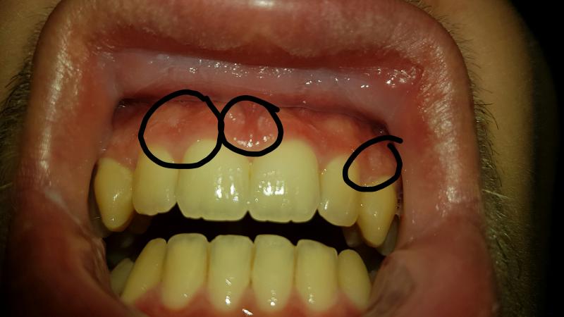 Weisse Punktchen Auf Zahnfleisch Denta Beaute