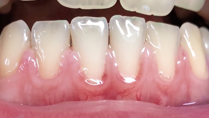 Zahnfleischbluten Nach Zahnextraktion Denta Beaute