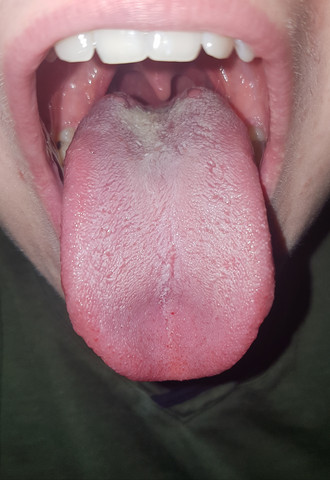 Normale Gesunde Zunge? 