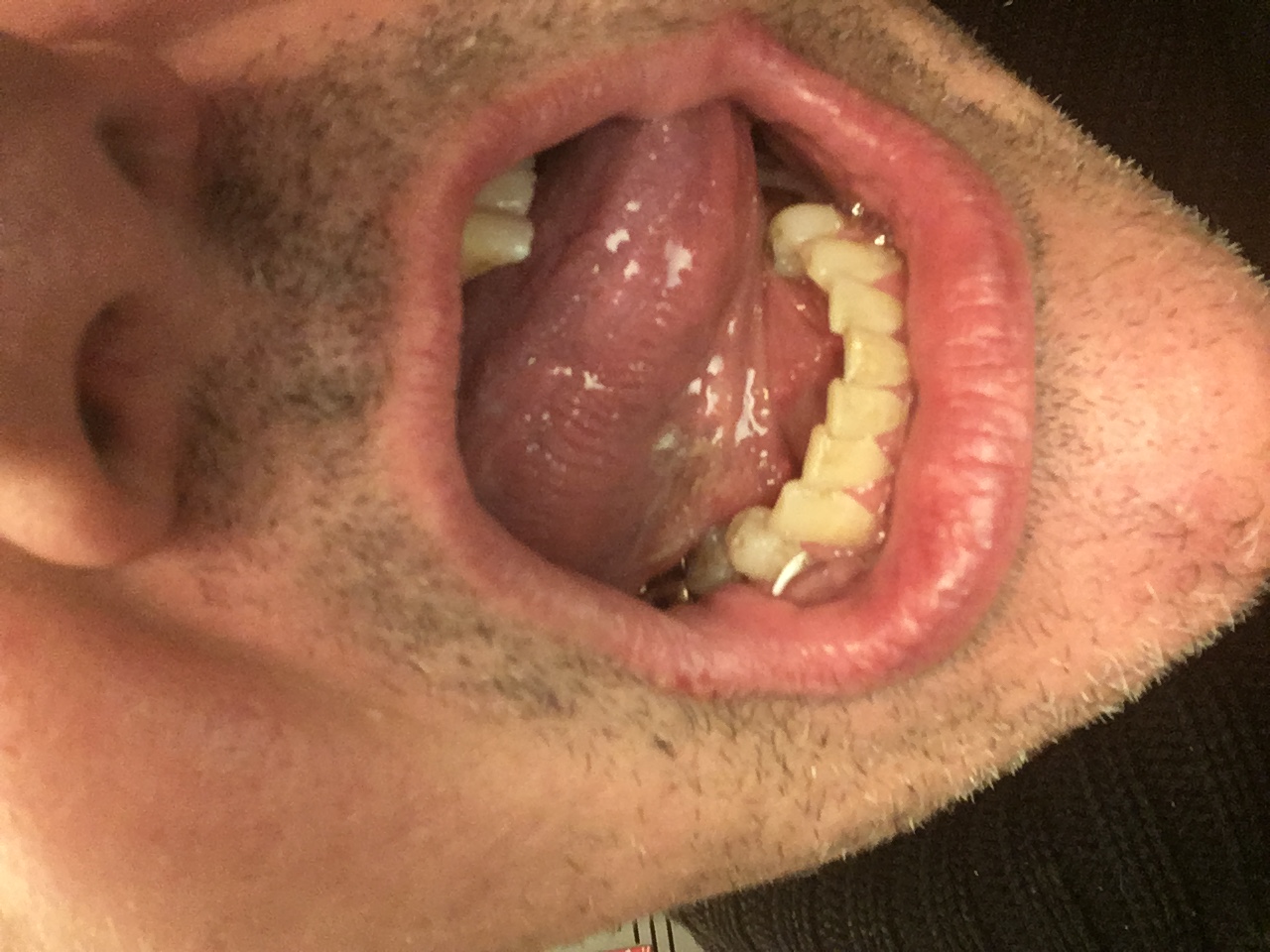 Zungenkrebs? Schleimhautveränderung unter der Zunge rechts und ...