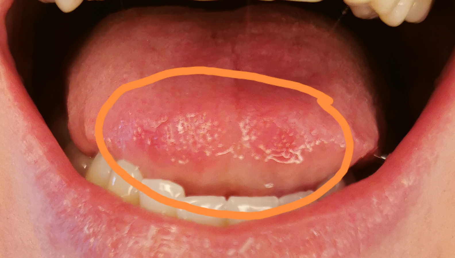 Hilfe! Krebs oder Pilz? Was ist das auf meiner Zunge? - Denta Beaute