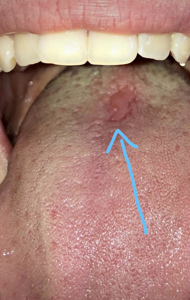 Fleck ohne Belag auf Zunge Denta Beaute