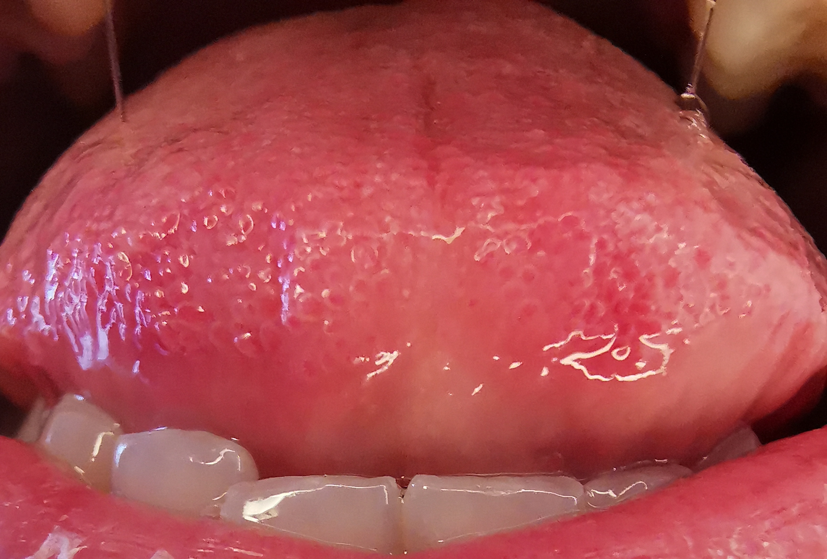 Hilfe! Krebs oder Pilz? Was ist das auf meiner Zunge? - Denta Beaute