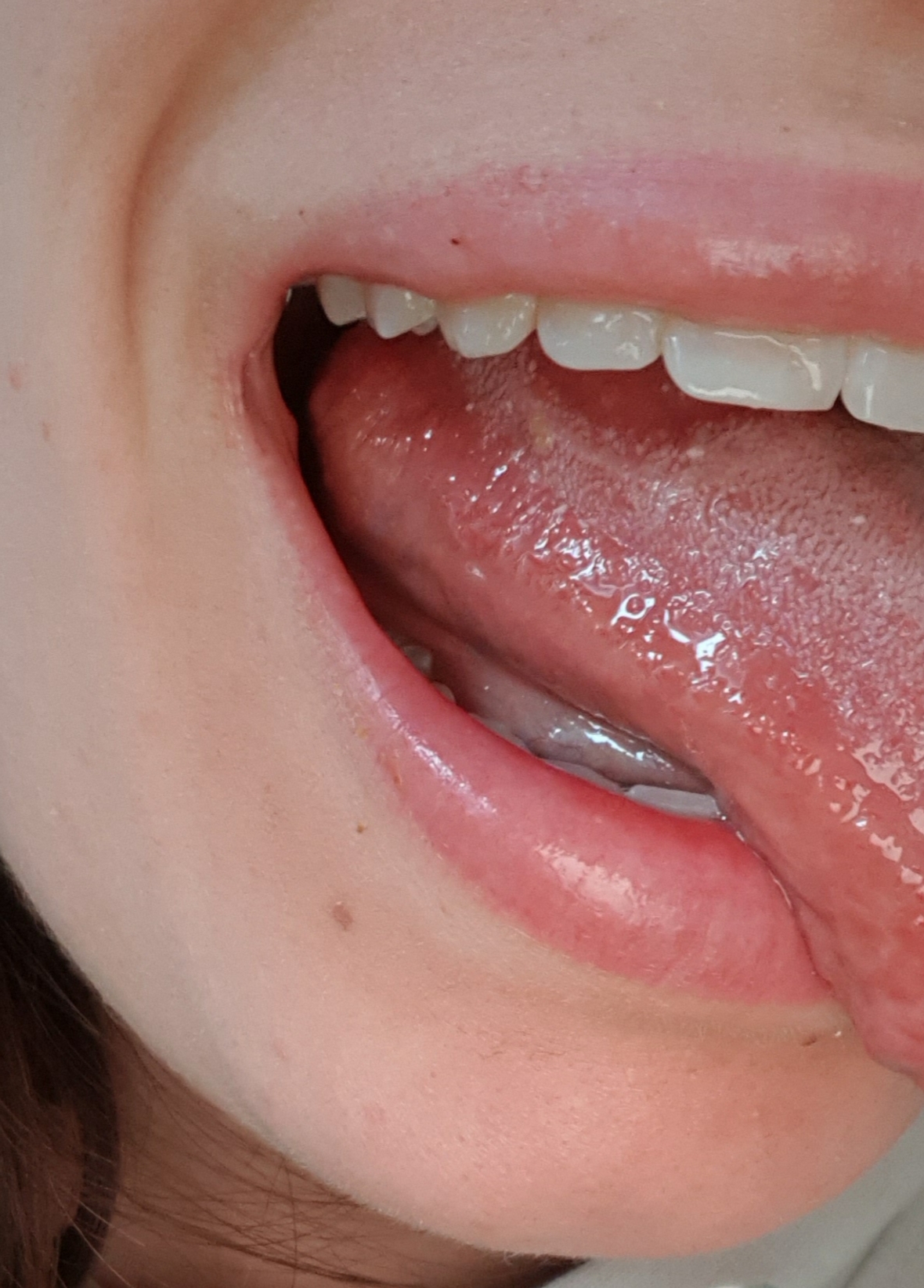 Zyste an der Zunge - Denta Beaute