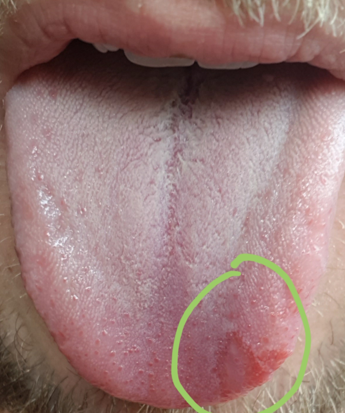 Was ist mit meiner Zunge los? 