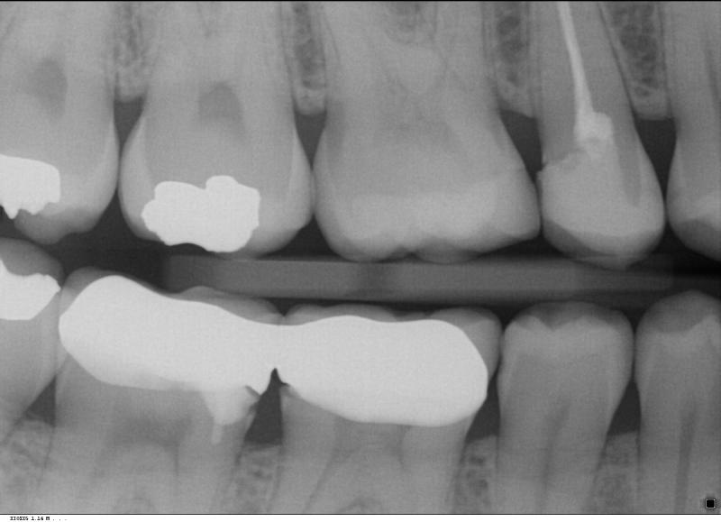 Karies unter Krone Denta Beaute