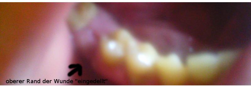 Gezogen wundheilung backenzahn Patientenfrage: Zahn